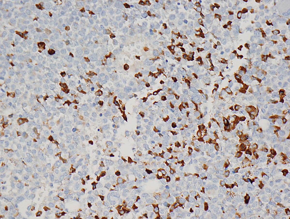 Primitive cells showed weak to absent lysozyme expression